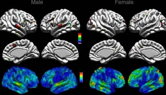 A step toward better understanding brain anatomy of autism spectrum disorder